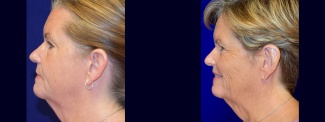 Left Profile View - Otoplasty