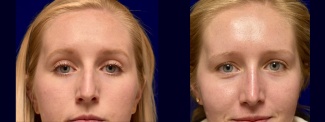 Frontal View - Rhinoplasty