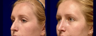 Left 3/4 View - Rhinoplasty