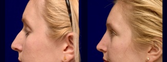 Left Profile View - Rhinoplasty