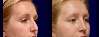 Right 3/4 View - Rhinoplasty