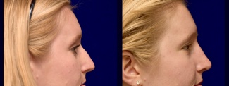 Right Profile View - Rhinoplasty