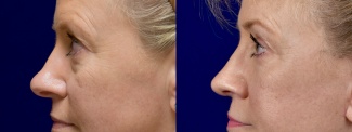 Left Profile View - Rhinoplasty