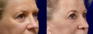 Left 3/4 View - Rhinoplasty