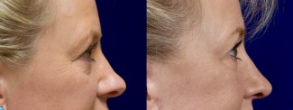 Right Profile View - Rhinoplasty